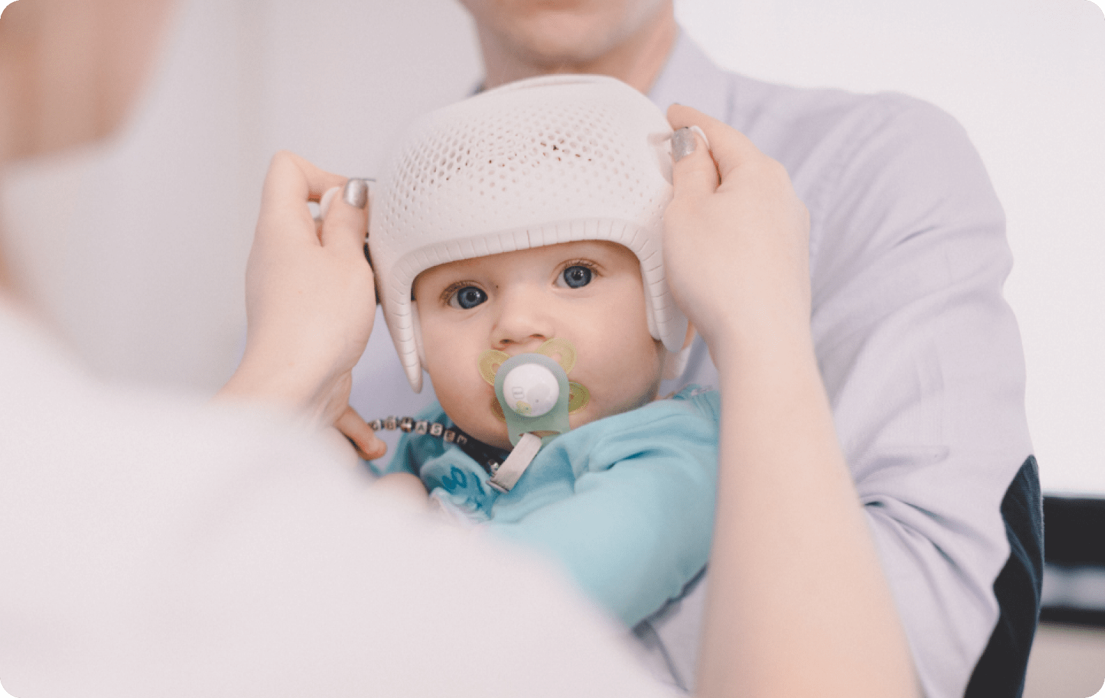 3D printed cranial remolding orthosis on a baby by Invent Medical